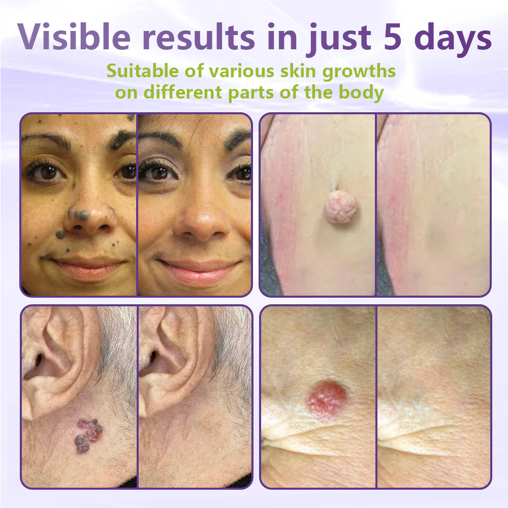 💖BUY 1 GET 1 FREE -✨LOVILDS™ SOLUBLE MICRONEEDLE BOTANICAL SKIN TAG REMOVAL PATCH