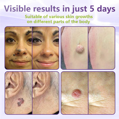 💖BUY 1 GET 1 FREE -✨LOVILDS™ SOLUBLE MICRONEEDLE BOTANICAL SKIN TAG REMOVAL PATCH