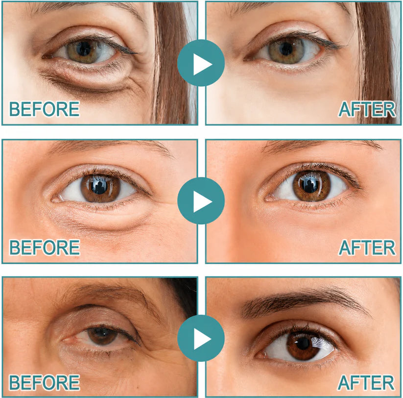 ✨Buy 1 Get 1 Free - Dissolving Microneedle Eye Patches