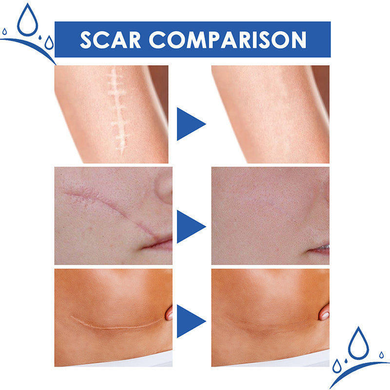 🔥Limited-time 60% sale--LOVILDS Scar Repair Cream — Smooth, Clear, Confident Skin