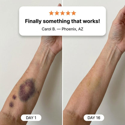 💥100K+ SOLD💕- LOVILDS® Bruise Repair & Skin-Strengthening Cream